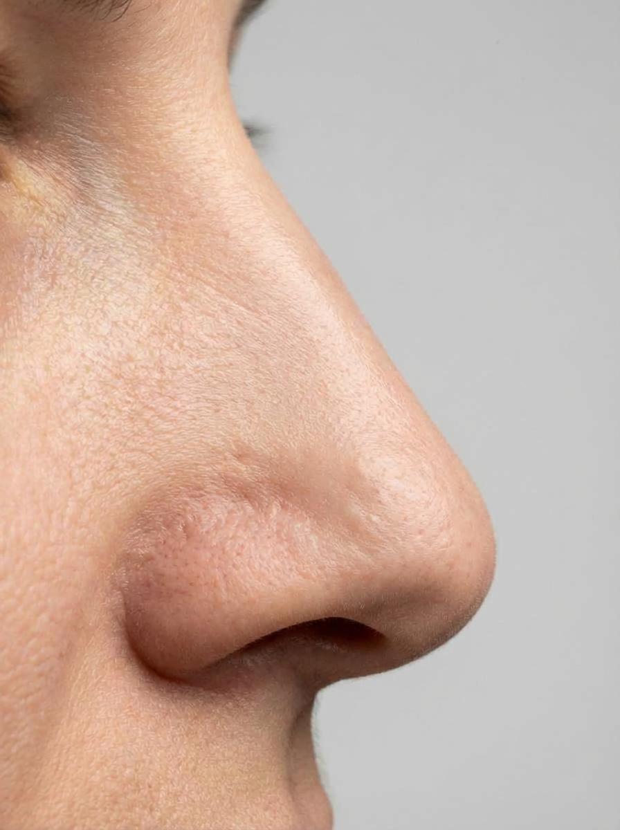 prima e dopo rinoplastica rinoplastica secondaria naso erba rinoplastica secondaria per migliorare naso foto dopo - 180