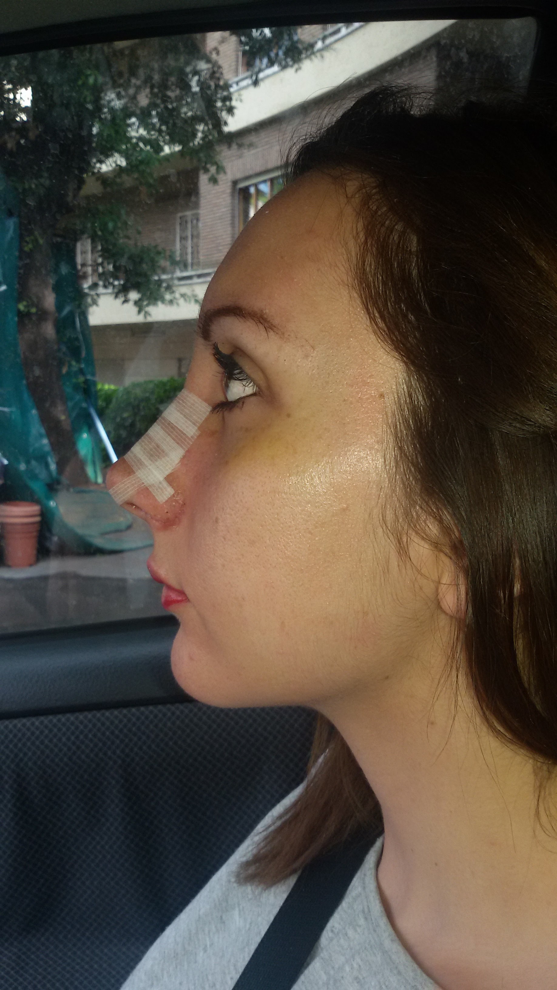 prima e dopo rinoplastica rinoplastica chiusa rinoplastica primaria naso donna roma rinoplastica a roma 26-30 anni foto 1 mese - 704