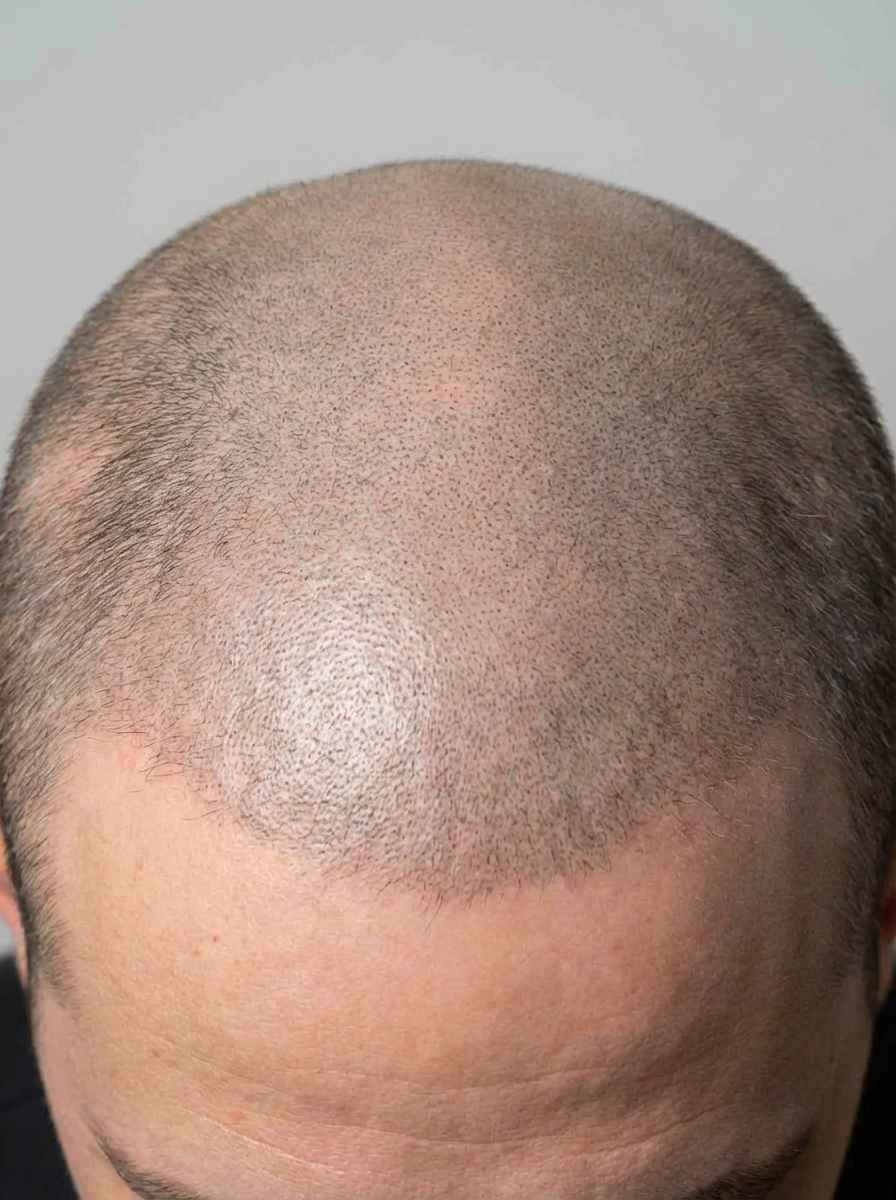 prima e dopo tatuaggio dermopigmentazione alopecia capelli gubbio dermopigmentazione alopecia per migliorare capelli foto dopo - 294