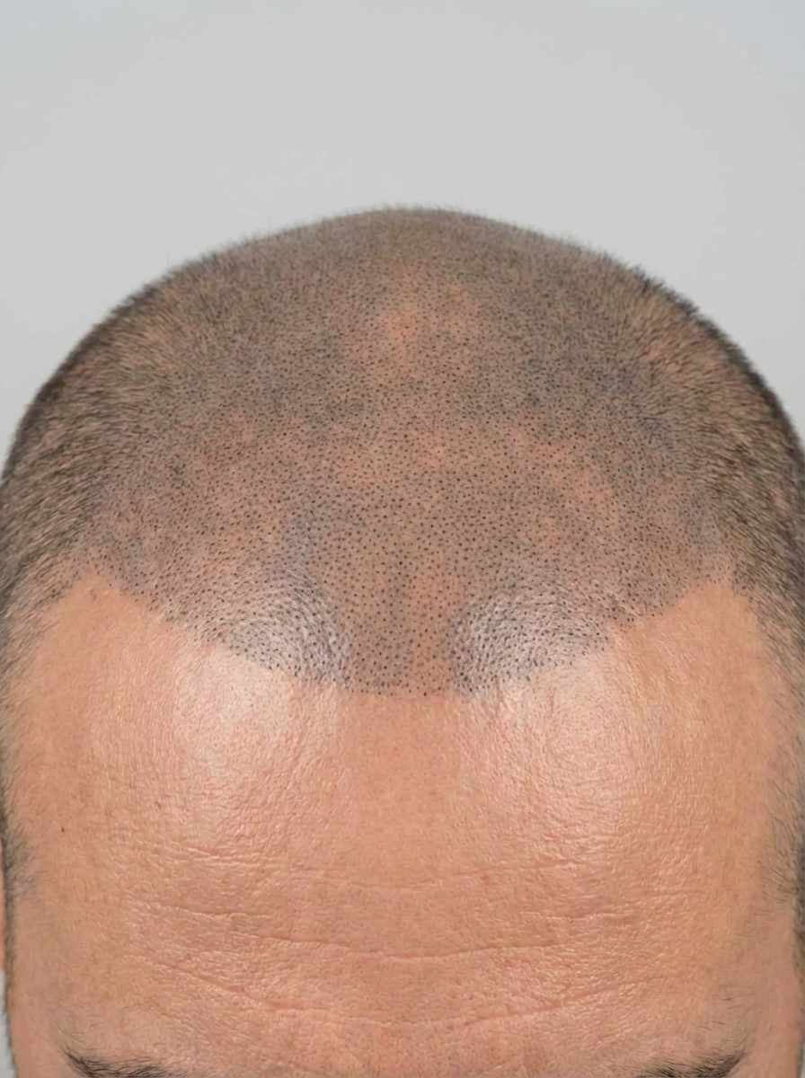 prima e dopo tricopigmentazione tricopigmentazione effetto rasato capelli badia tricopigmentazione effetto rasato per migliorare capelli foto dopo - 640