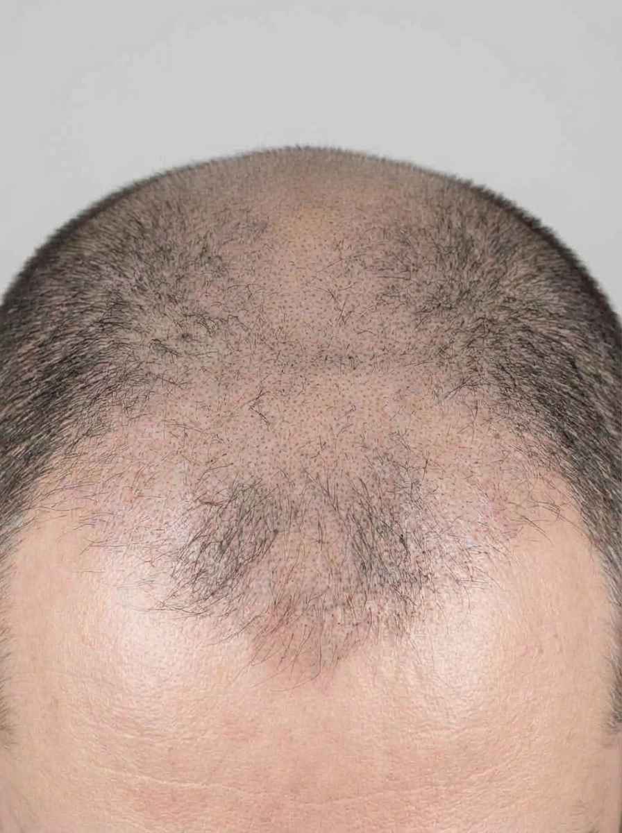 prima e dopo tricopigmentazione tricopigmentazione cicatrici capelli colfosco tricopigmentazione cicatrici per migliorare capelli foto dopo - 642