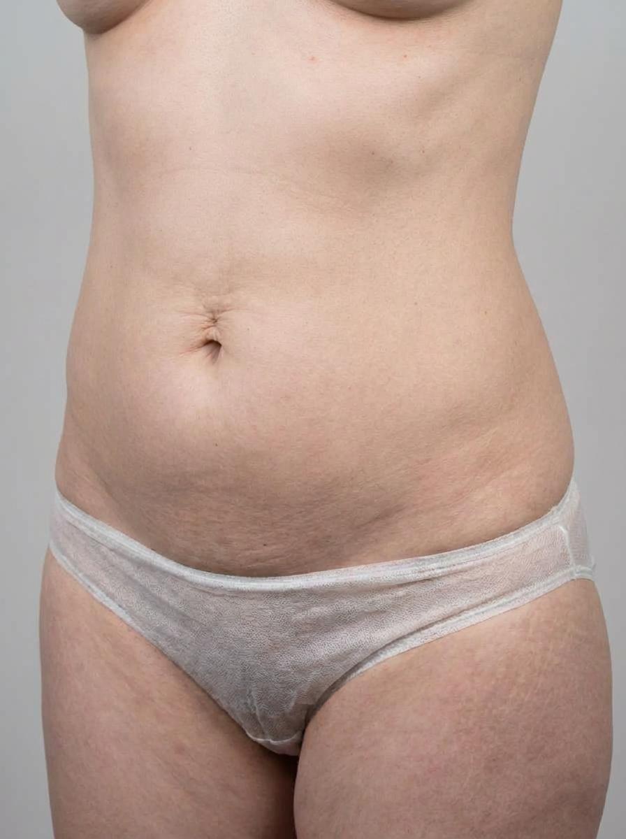 prima e dopo velashape velashape body contouring corpo porto empedocle velashape body contouring per migliorare corpo foto dopo - 521